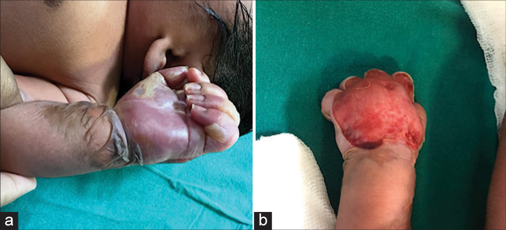 Clinical images of the baby showing features of acute limb ischemia. (a) ventral surface and (b) dorsal surface.